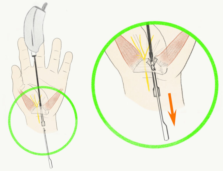 手根管解放のリスク